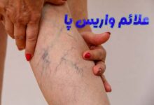 علائم واریس پا