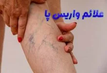 علائم واریس پا
