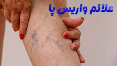 علائم واریس پا