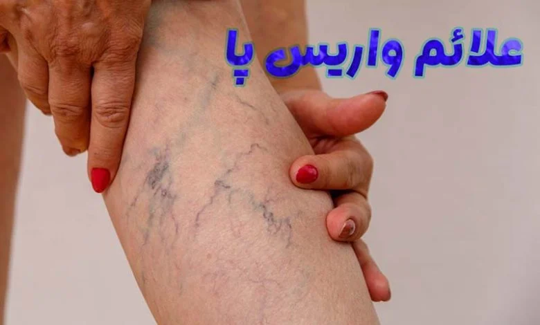 علائم واریس پا