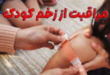 مراقبت از زخم کودکان