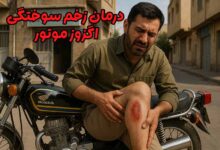 زخم سوختگی اگزوز