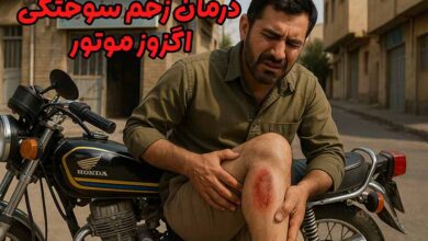زخم سوختگی اگزوز