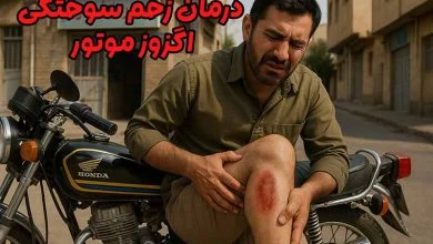 زخم سوختگی اگزوز
