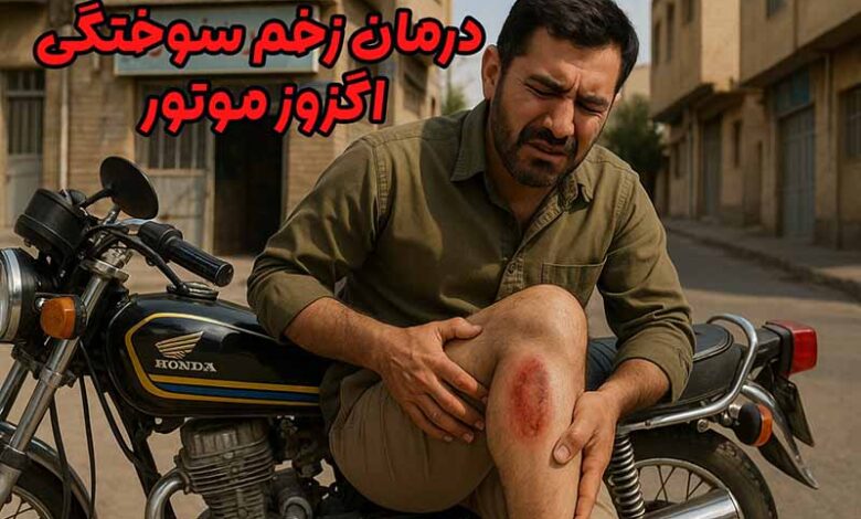 زخم سوختگی اگزوز