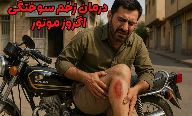 زخم سوختگی اگزوز