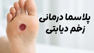 پلاسما درمانی زخم دیابتی