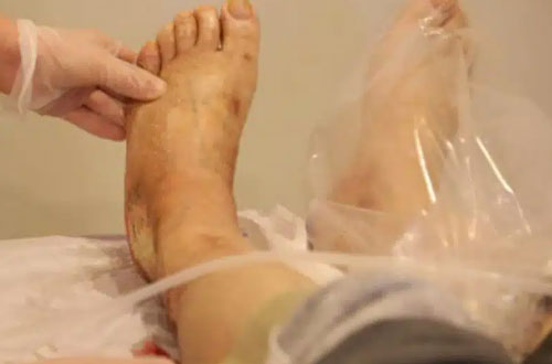 اوزون-تراپی