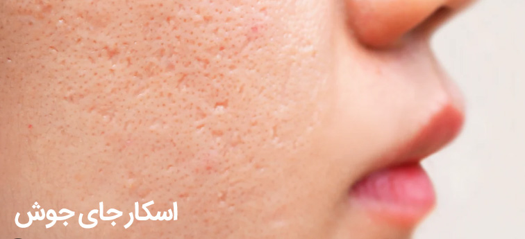 از بین بردن جای زخم روی صورت