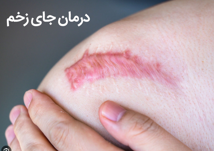 بهترین راهکارها  برای کاهش اثرات زخم