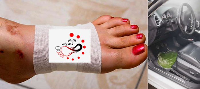علائم و عوارض سوختگی با آب جوش و بخار رادیاتور
