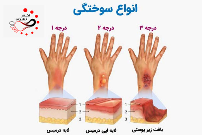 شناخت انواع درجه سوختگی و علائم آن