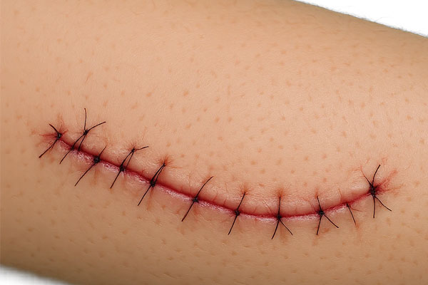 زخم عمل زیبایی