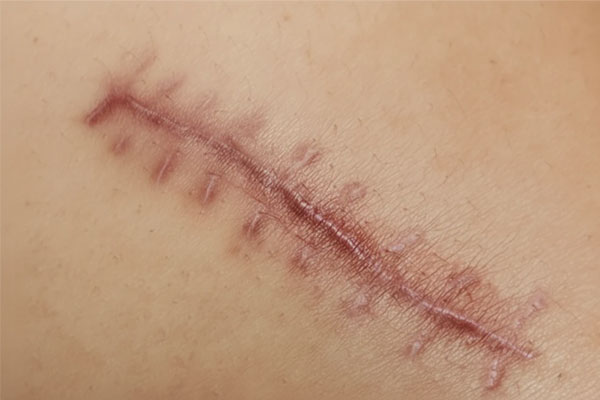 درمان زخم زیبایی