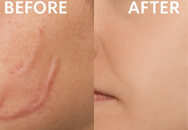 درمان زخم زیبایی