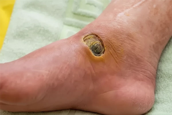 کلینیک زخم بستر و دیابتی تهران