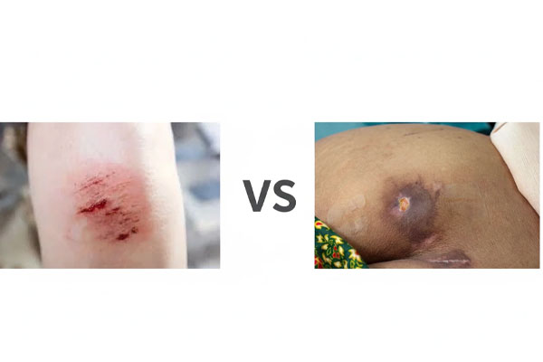 تفاوت-زخم-فشاری-سطحی-و-عمیق